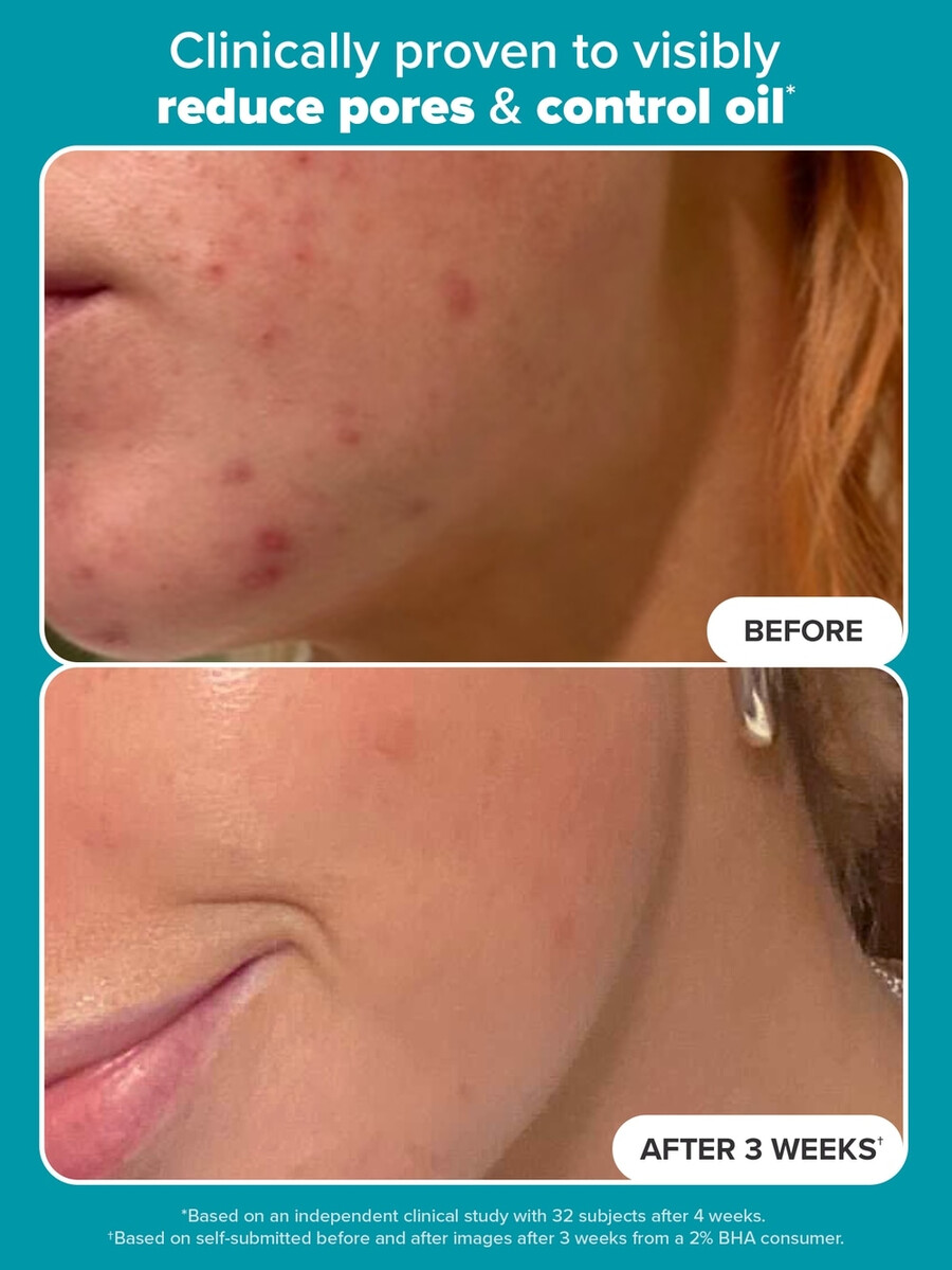 huidverfijnende vloeibare exfoliant met 2 bha